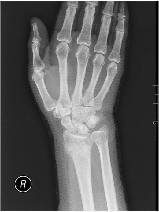 Using a Support after Wrist Fracture Essential Wellness
